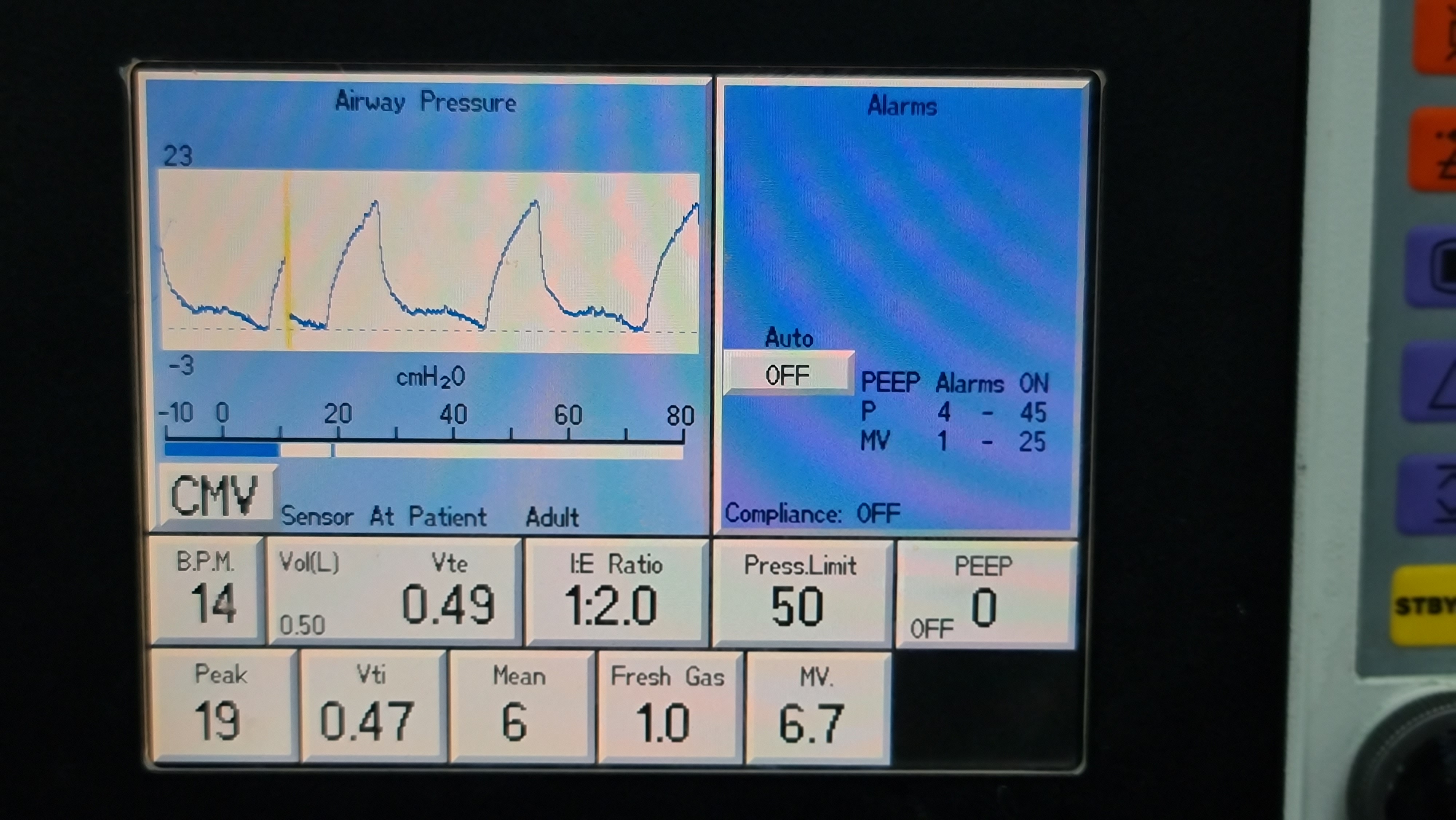 Chế độ thở thể tích CMV / Control Mandatory Ventilation.