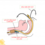 ỐNG NỘI KHÍ QUẢN CÓ DÂY HÚT