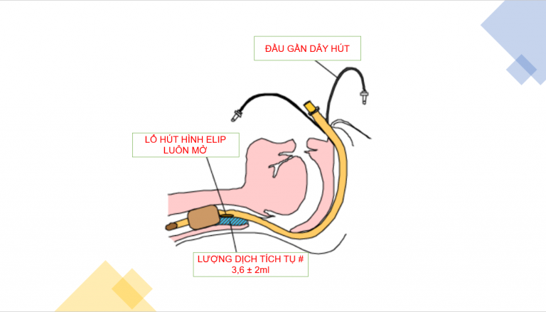 Ống NKQ Hilo Evac.