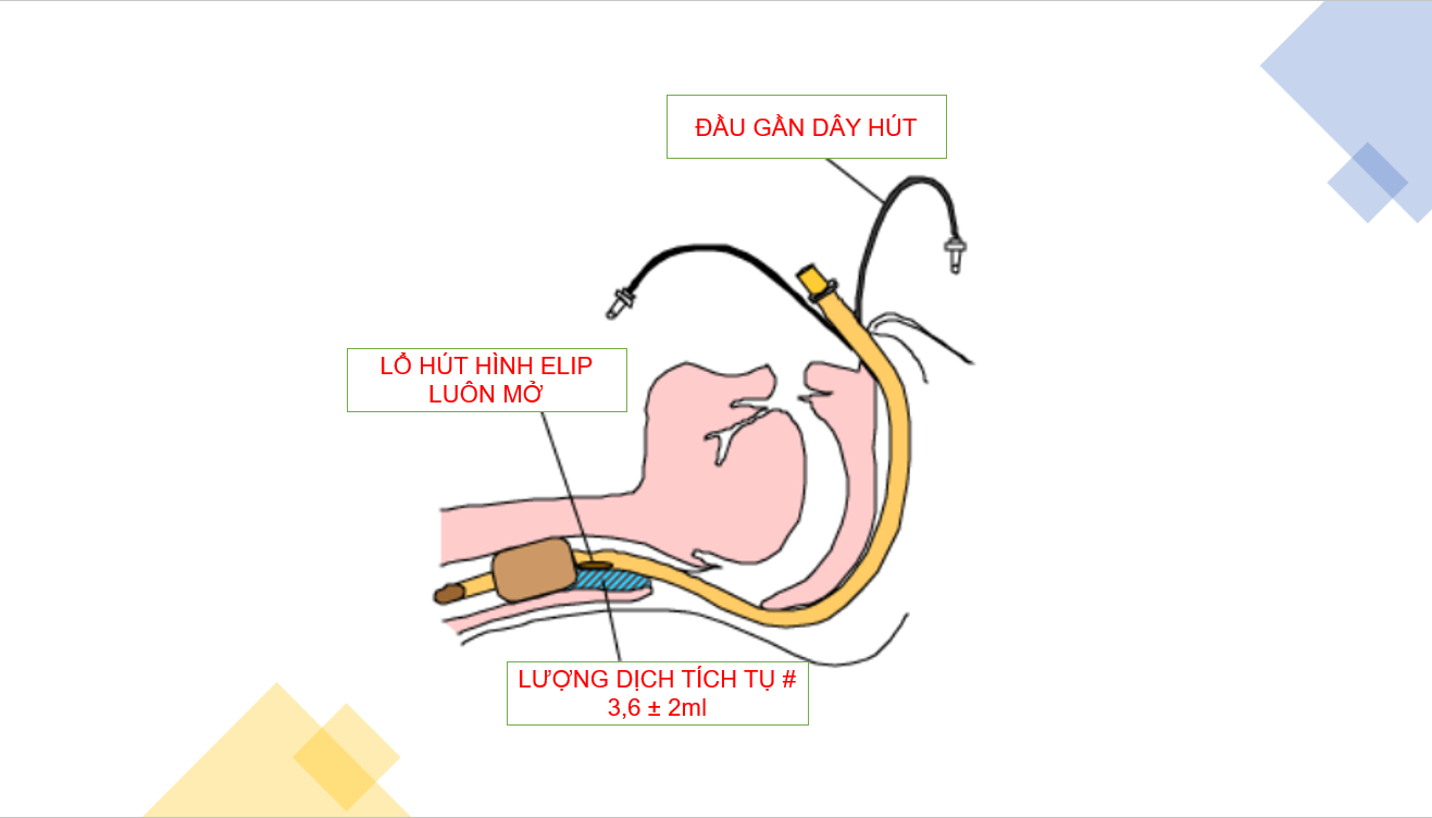 ỐNG NỘI KHÍ QUẢN CÓ DÂY HÚT