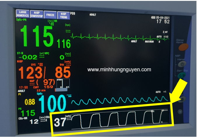 NỒNG ĐỘ CO2 CUỐI KỲ THỞ RA TRONG GMHS