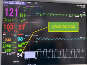 THÔNG SỐ EtCO2 TIÊU CHÍ VÀNG ĐẶT NKQ THÀNH CÔNG