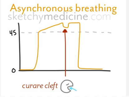 ETCO2 WITH CURARE CLEFT