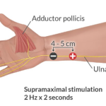 CÁCH MÁC ĐIỆN CỰC ĐO TOF