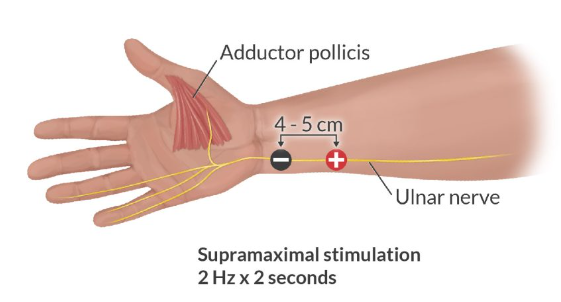 CÁCH MÁC ĐIỆN CỰC ĐO TOF