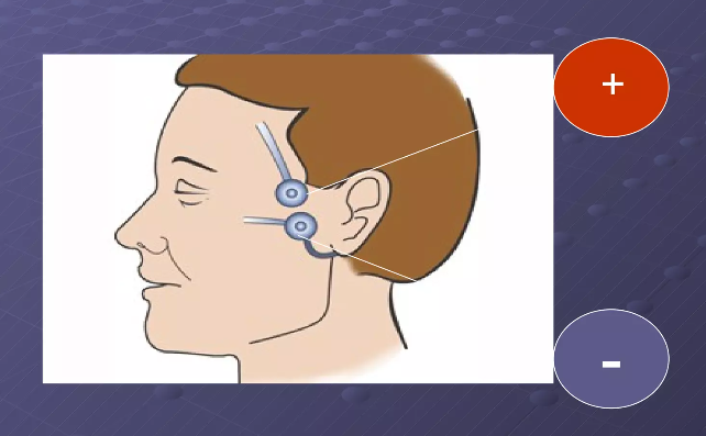 ĐO TOFtrên dây thần kinh mặt (cơ vòng mắt/cơ mày).