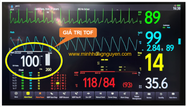 TOF = 100 TỐI ƯU CHO RÚT NỘI KHÍ QUẢN