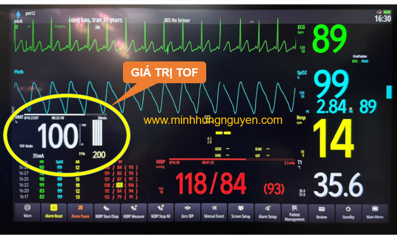 TOF = 100 TỐI ƯU CHO RÚT NỘI KHÍ QUẢN