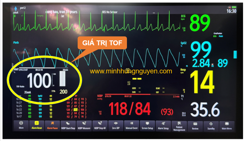 TOF = 100 TỐI ƯU CHO RÚT NỘI KHÍ QUẢN