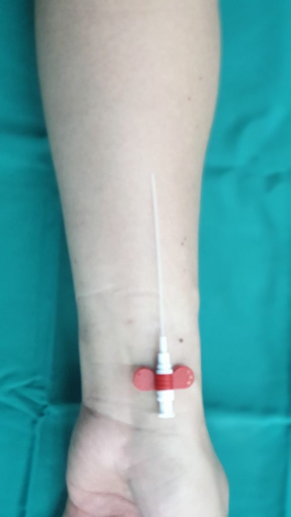 VỊ TRÍ LUỒN CATHETER THƯỜNG LÀ ĐỘNG MẠCH QUAY.