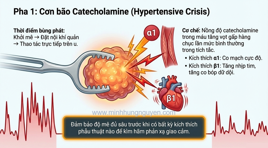 CƠN BÃO CATECHOLAMINE TRONG PT U TỦY THƯỢNG THẬN