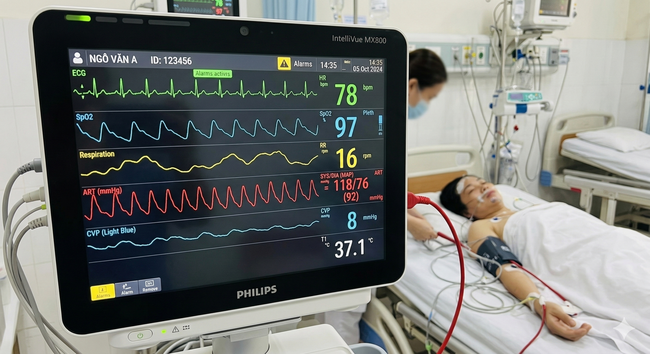 THEO DÕI HUYẾT ÁP ĐỘNG MẠCH XÂM LẤN