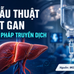 LIỆU PHÁP TRUYỀN DỊCH TRONG PT CẮT GAN