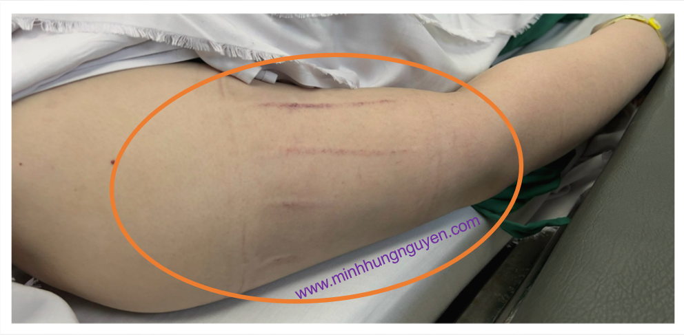 TỤ MÁU DO ĐO HUYẾT ÁP KHÔNG XÂM LẤN