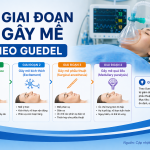 4 GIAI ĐOẠN GÂY MÊ THEO GUEDEL
