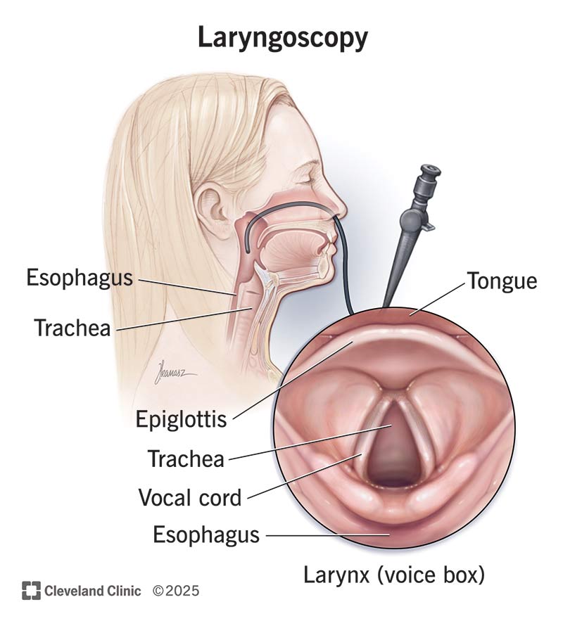 laryngoscopy