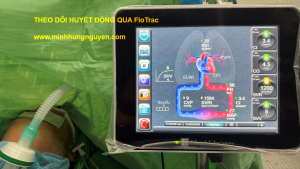 FloTrac trong GMHS